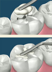 Sâu răng: diễn biến, nguyên nhân, điều trị và dự phòng