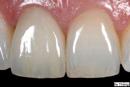 So sánh Răng bọc sứ và Răng phủ Composite