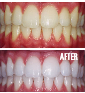 Răng tối màu và các phương pháp làm cho răng sáng hơn