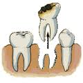Những lưu ý trước và sau khi nhổ răng