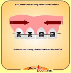 Sự dịch chuyển răng trong quá trình nắn chỉnh răng