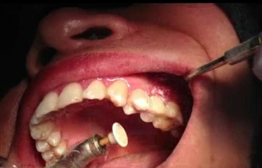Implant răng 2.5, tạo phục hình ngay bằng Composite