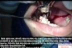 Video nhổ răng