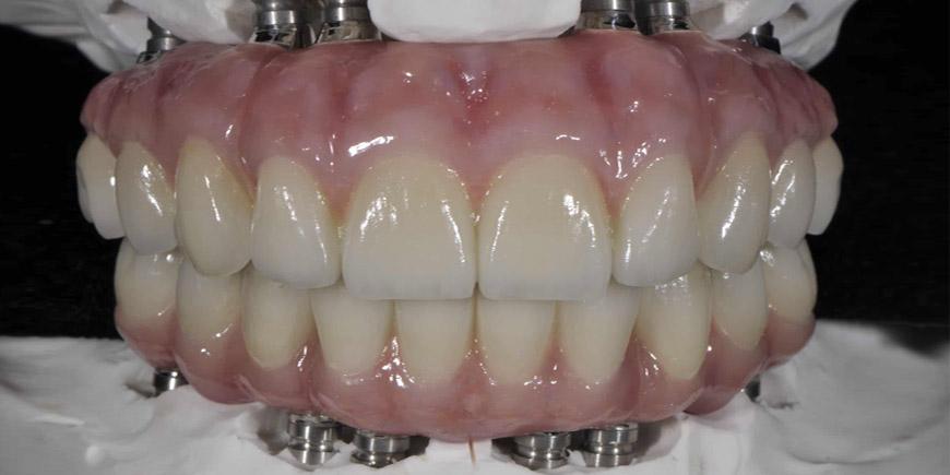 Thân răng Hybrid nhựa cường lực, thanh bar kim loại
