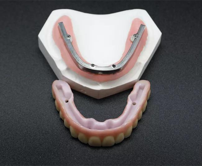 Thân răng sứ (Cercon, Ceramil, Zirconia) nguyên khối liền lợi gắn liên kết với thanh Bar hợp kim