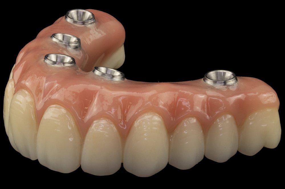 Thân răng sứ liền lợi đắp trực tiếp trên thanh Bar hợp kim