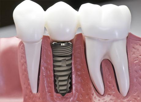 Cấy chân răng Implant nâng đỡ thân răng sứ