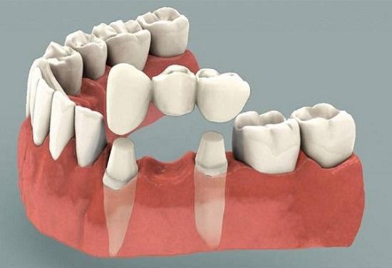 Làm cầu răng sứ gắn chặt lên hai răng bên cạnh răng mất